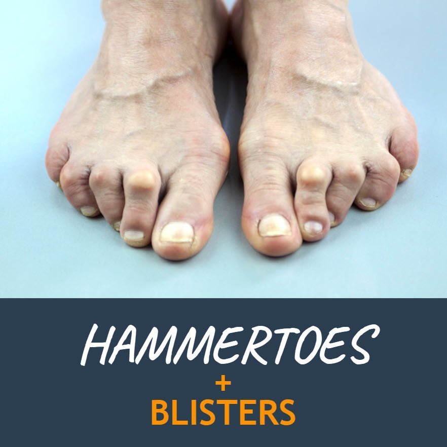 http://www.blister-prevention.com/cdn/shop/articles/882-hammertoes-triad-foot-and-ankle-centre.jpg?v=1682666609&width=2048