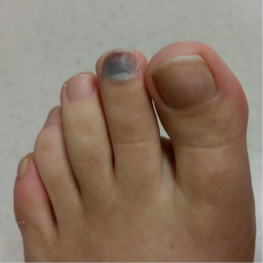 Black Toenail Treatment, Causes & Prevention - Blister Prevention - Rebecca  Rushton