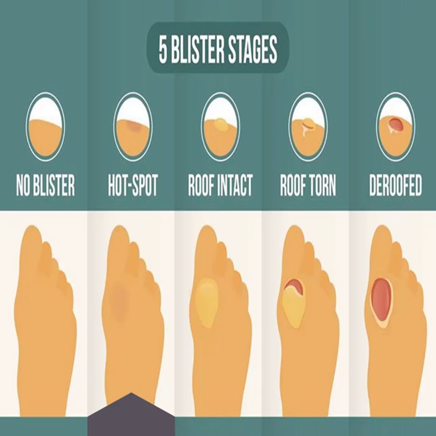 a hotspot is a pre-blister state