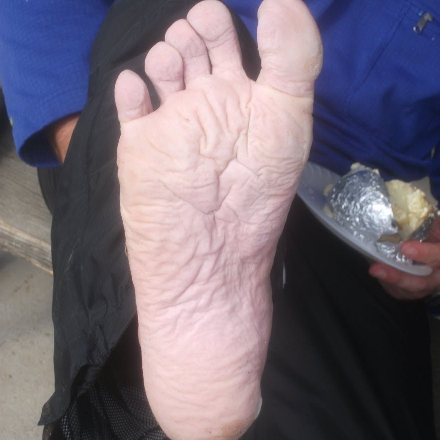 maceration prevention