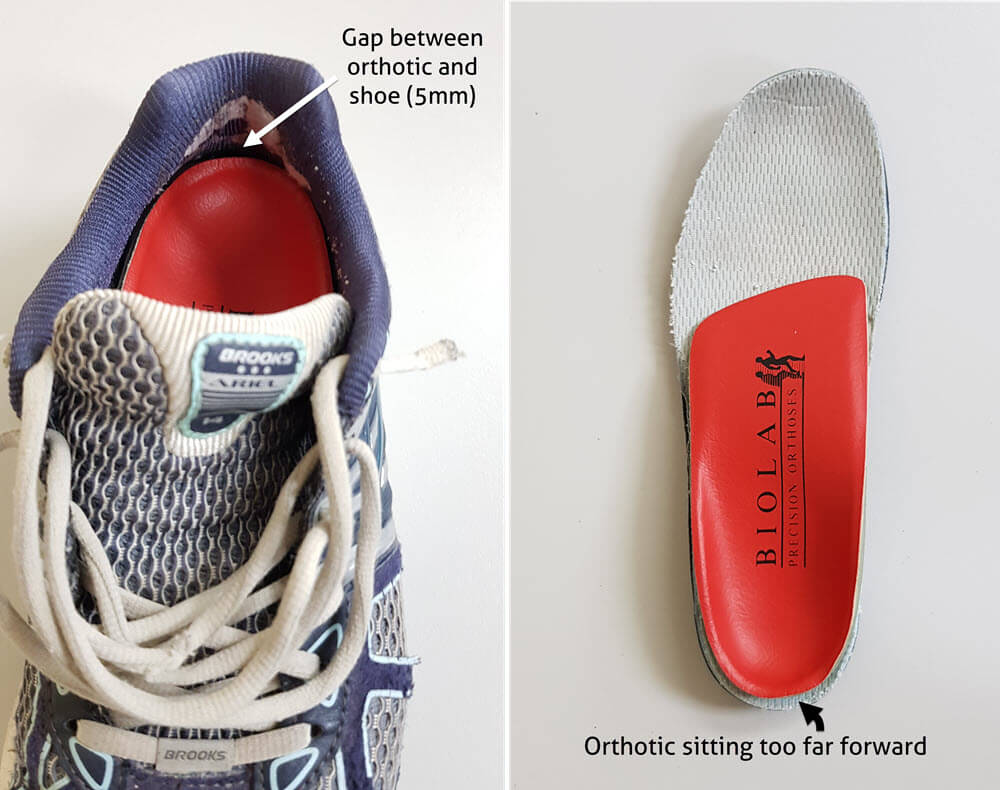 Orthotic sitting too far forward in the shoe can cause posterior heel edge blisters