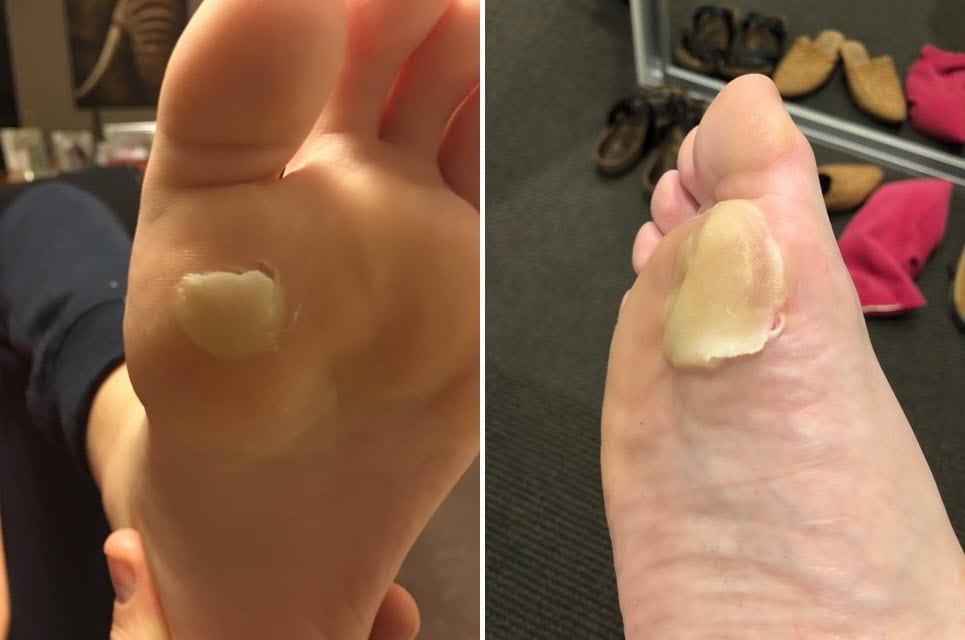 Plantar first metatarsal head blisters