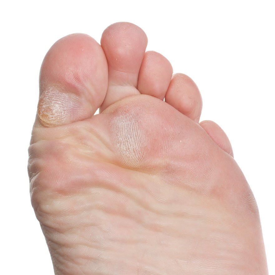 are callouses protective of blisters