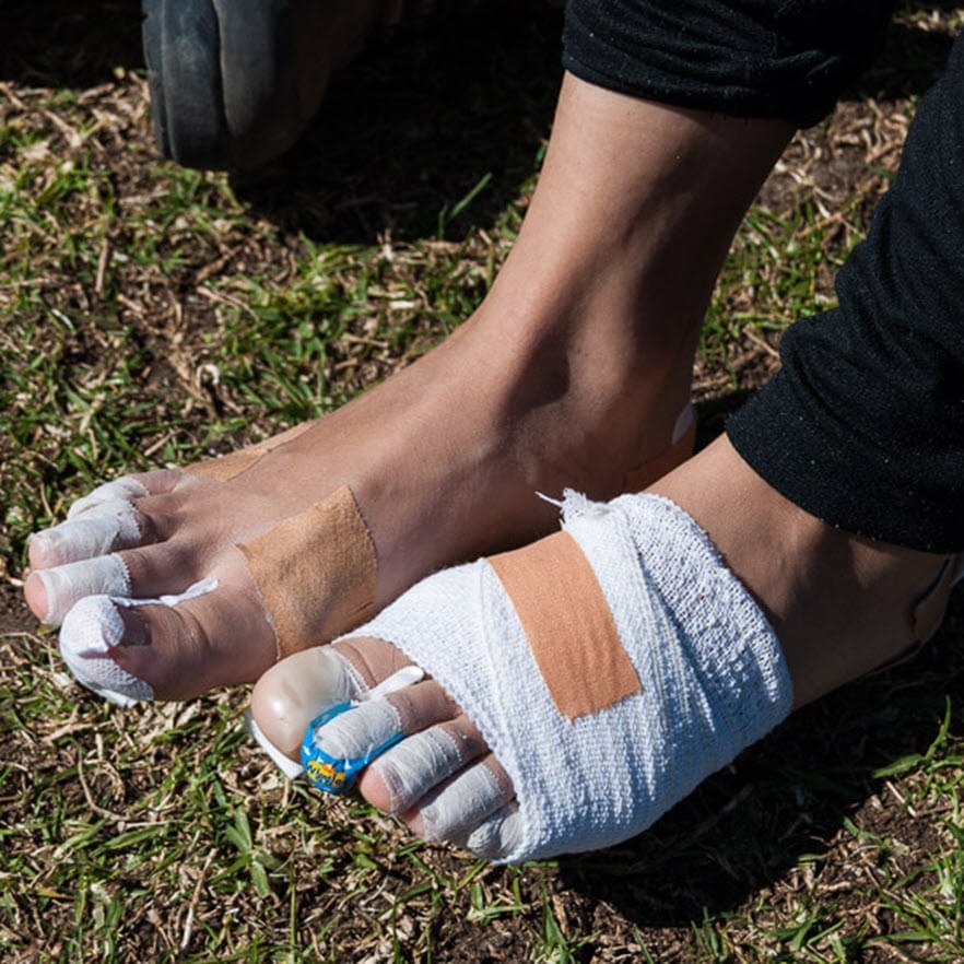 blister prone feet bandaged