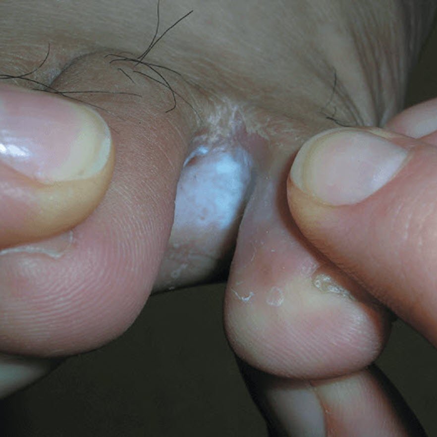 itchy foot blisters could be tinea pedis