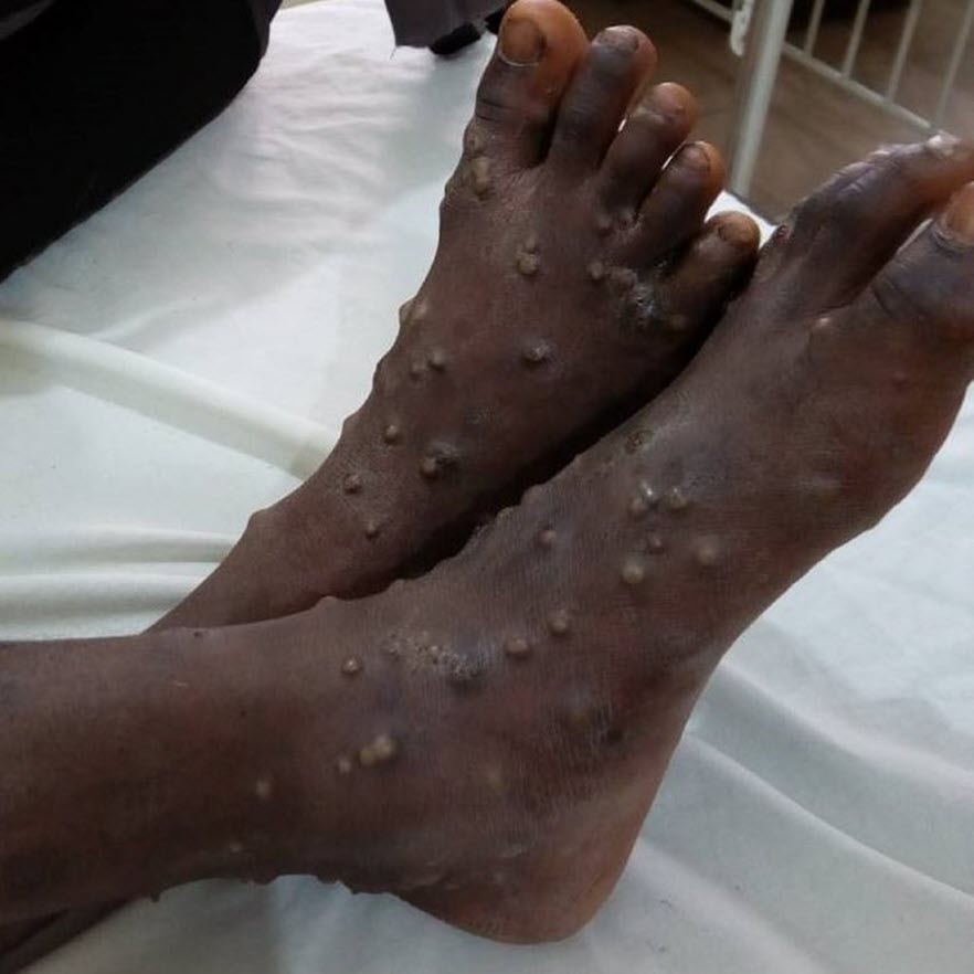 monkeypox blisters