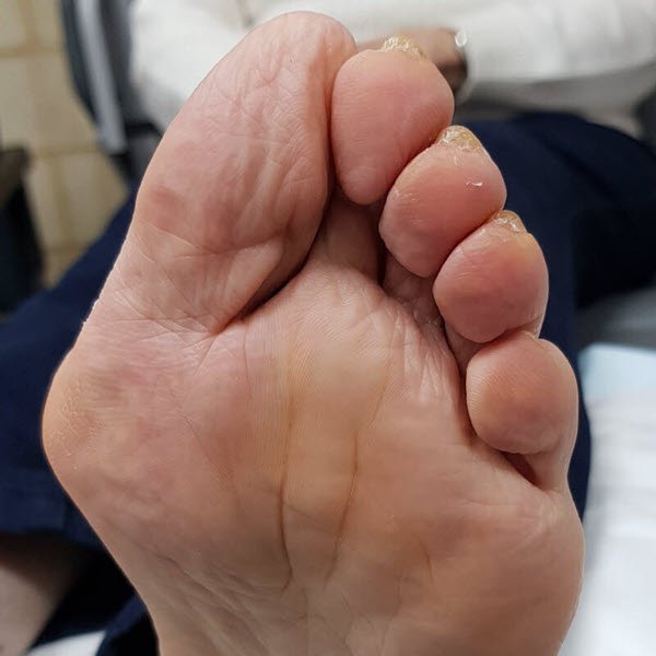 bunions and blisters