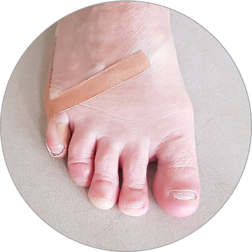 hold a curly toe straight with tape