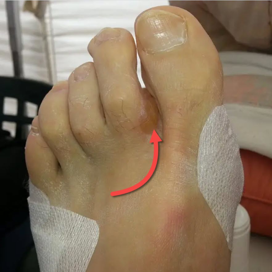 distal forefoot blister appearing between the toes