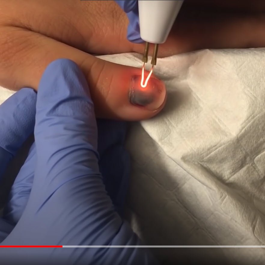 drill a hole in your nail with electrocautery - nail trephination