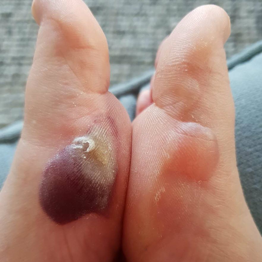 Blister Fluid Colours: What's Inside Your Blister? - Blister Prevention -  Rebecca Rushton