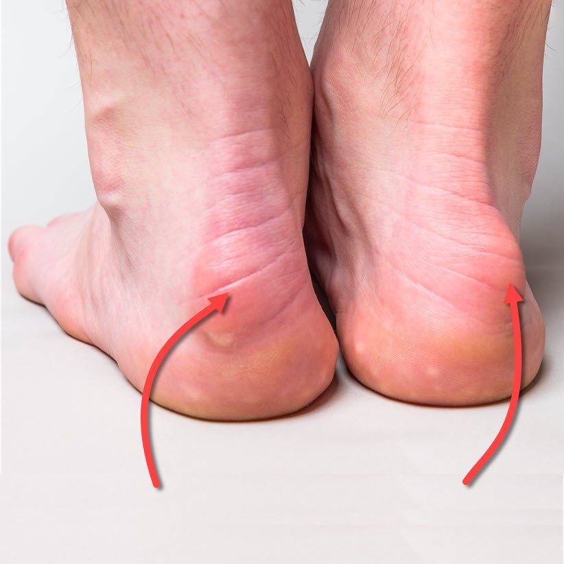 haglunds deformity and heel blisters