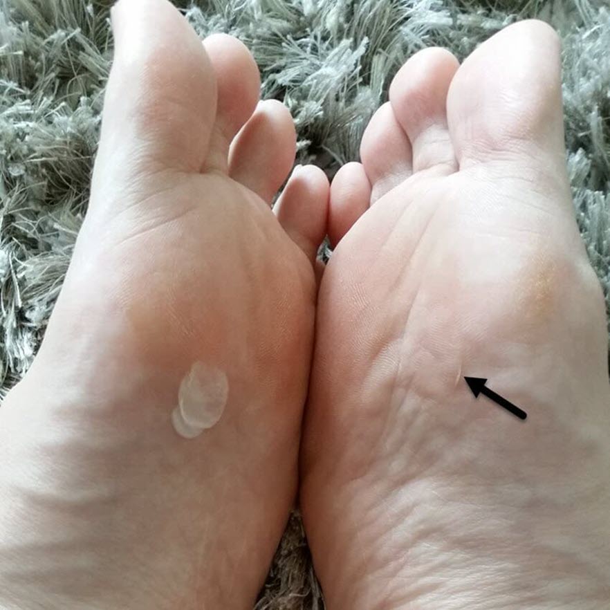 how long does it take for a blister to heal blister healing time
