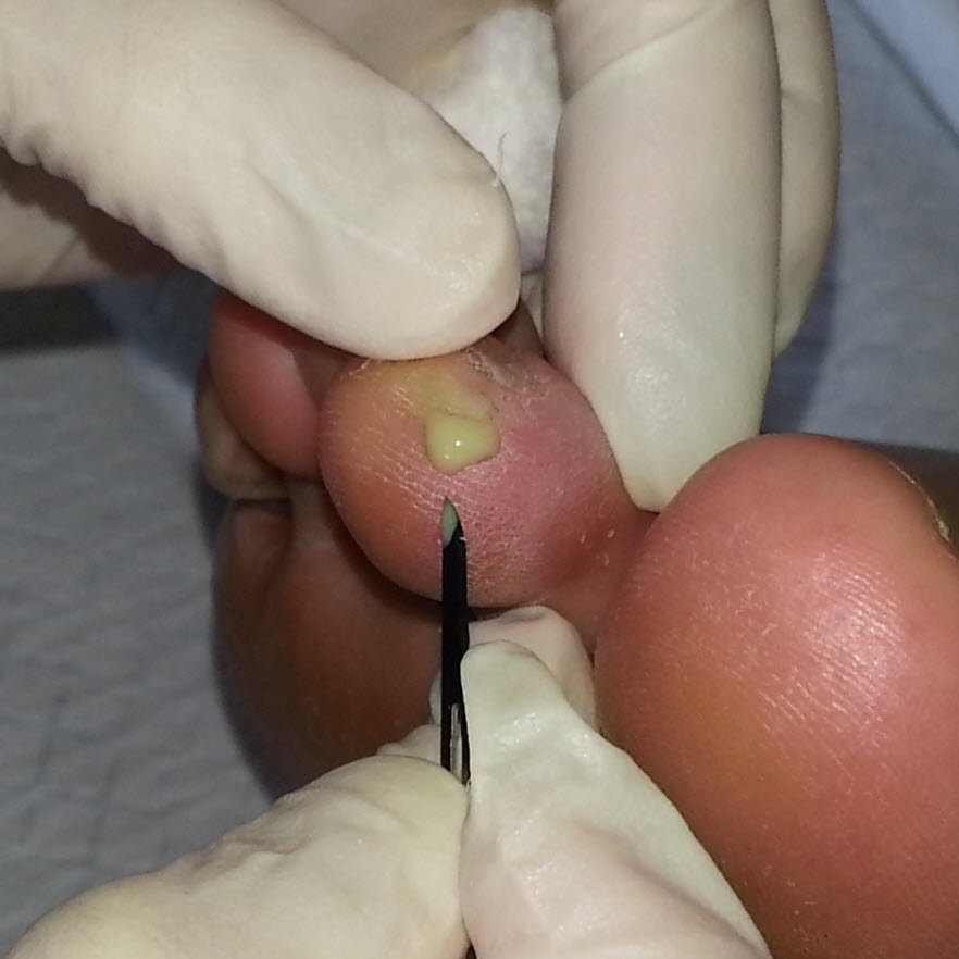 infected blister on toe lance pus