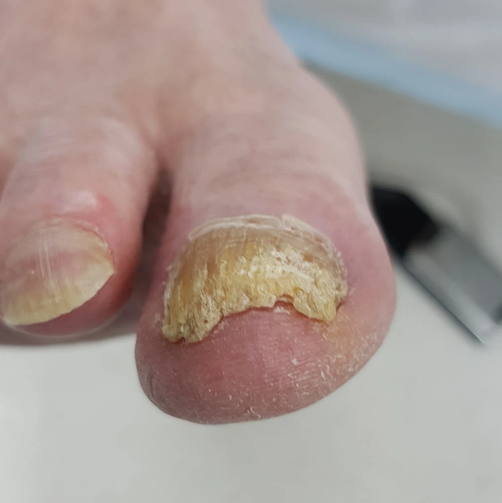 thick toenail with fungal infection before trimming
