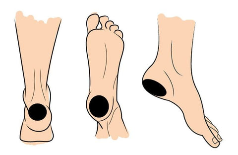 3 types of heel blisters