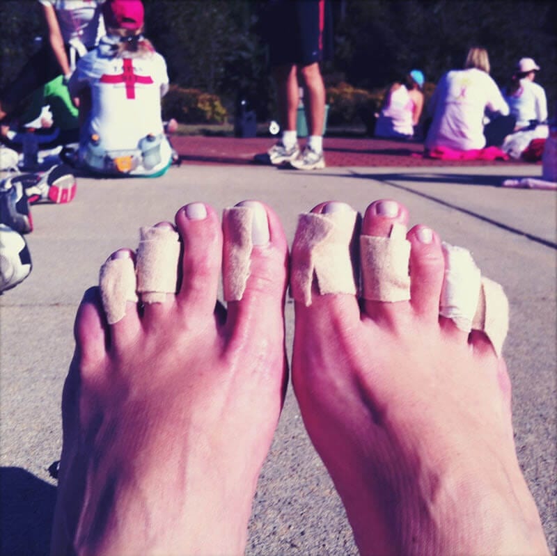 Hammertoes, Claw Toe, Mallet Toe And Blisters - Blister Prevention -  Rebecca Rushton