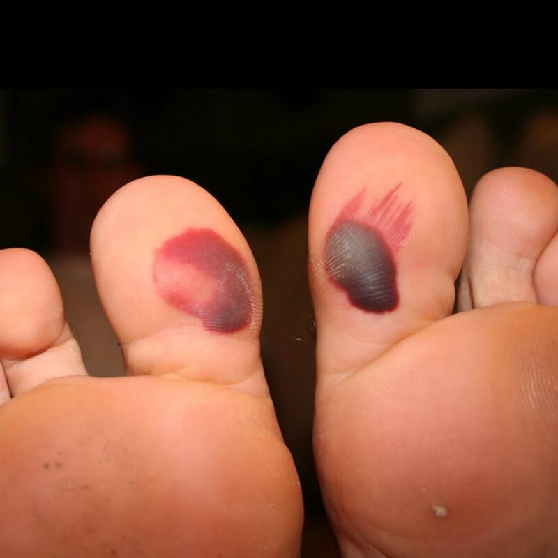 blood blisters on big toes