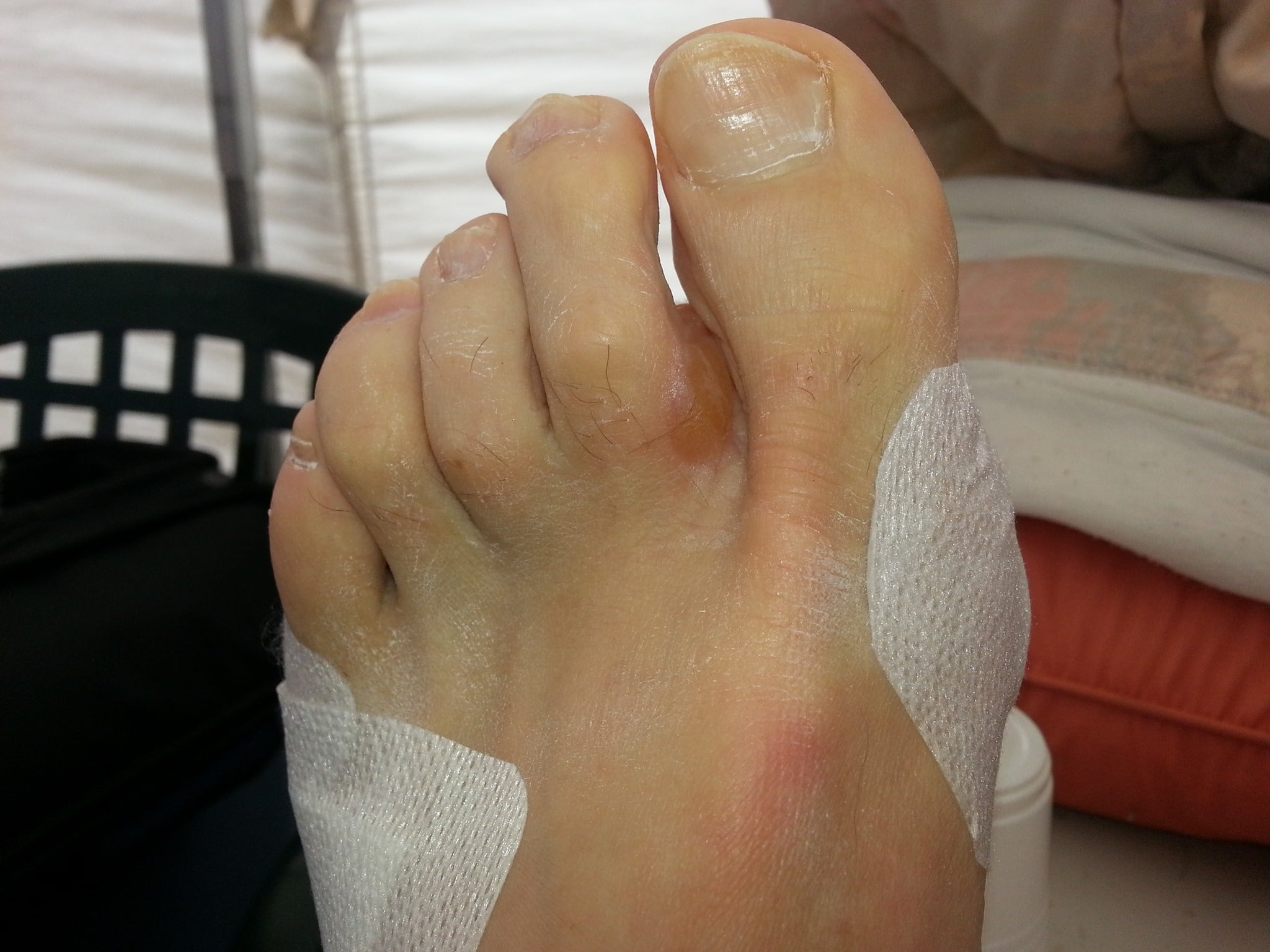 See the blister appearing between the toes