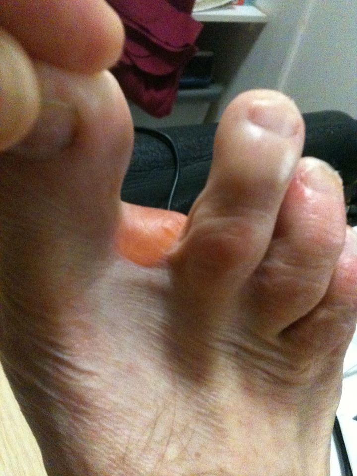 Another distal forefoot blister coming up between the toes