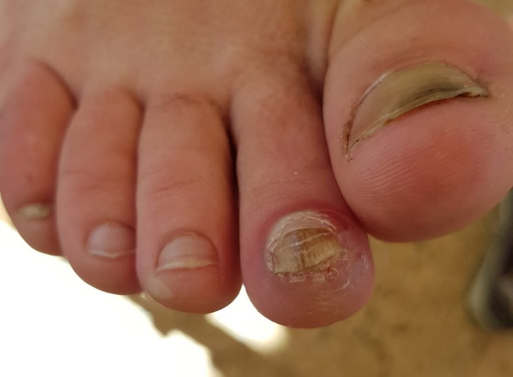 Thick toenail leading to blister