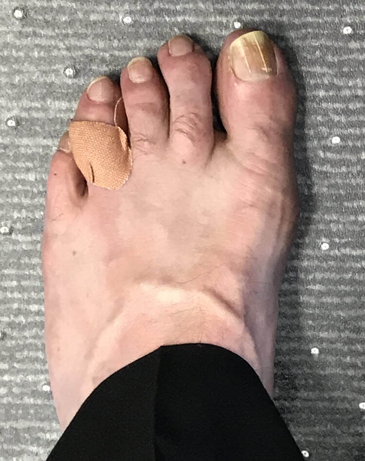 Ashley's infected corn between toes