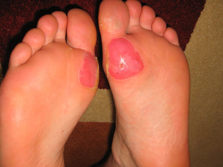 ball of foot deroofed blisters