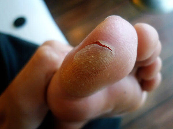 big toe edge blister