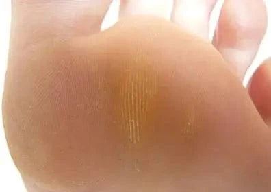 Callous under ball of foot