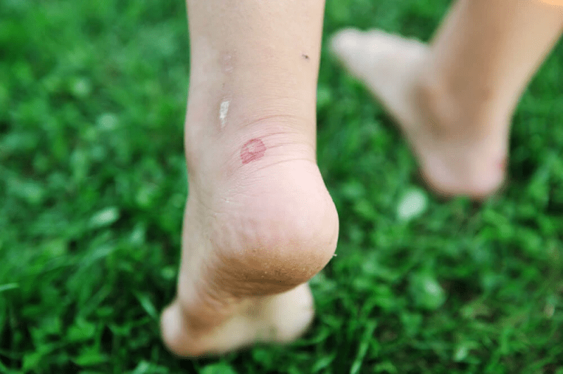 defoofed blister