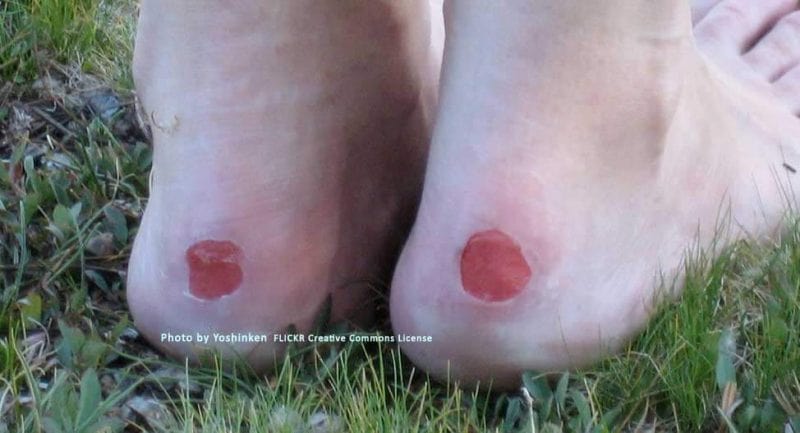hydrocolloid dressings are for deroofed blisters 