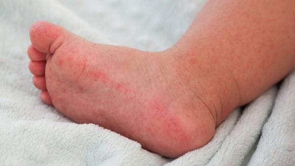 Hand, foot and mouth disease