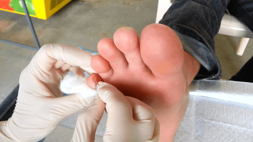 Normal healthy uninfected blister