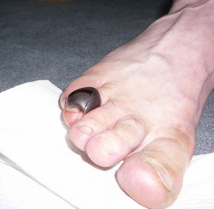 toe blood blister