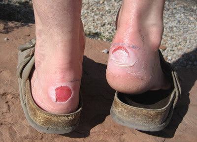 Wearing open-backed scuffs with take pressure off a foot blister