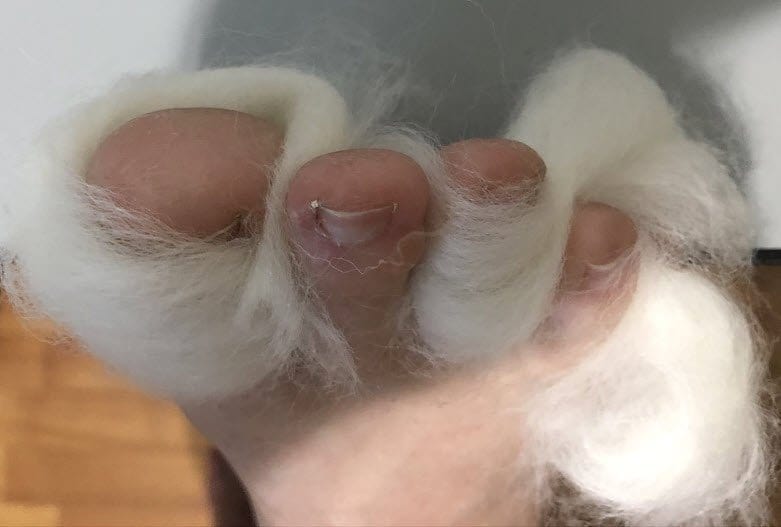 Could You Be Using Wool For Blisters On Your Toes? - Blister Prevention -  Rebecca Rushton