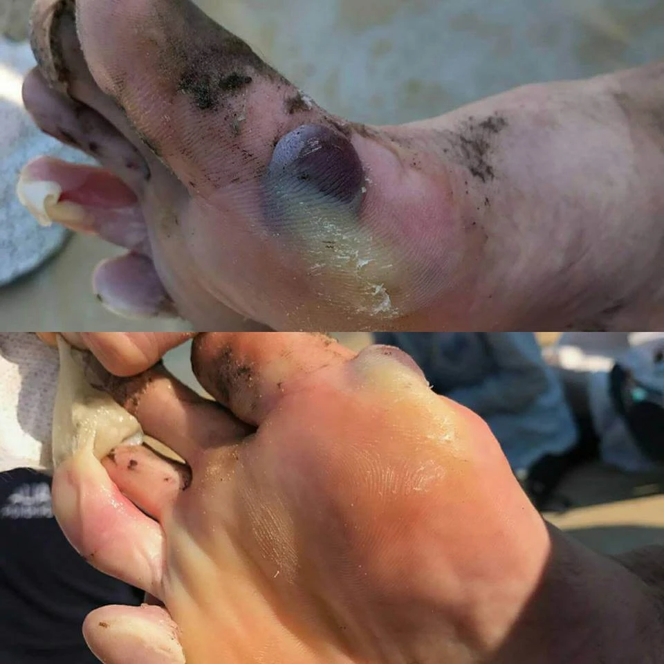 worst blister on the toes and forefoot