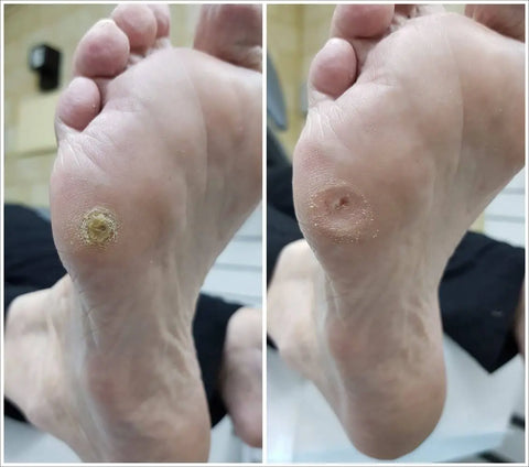 before and After: A corn with surrounding callous under the 5th metatarsal head.
