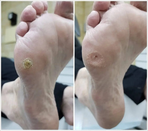 Callous Corns On Feet Similarities To Blisters Callous Corns On Feet Similarities To Blisters