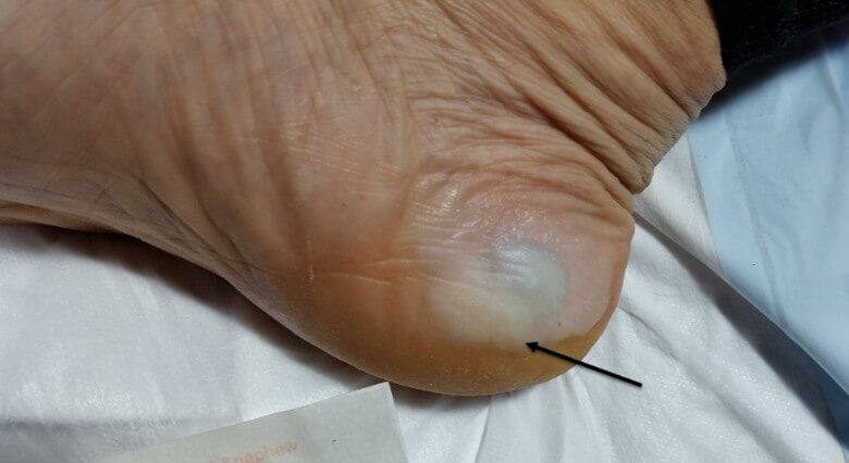 This is a macerated but intact medial heel edge blister which is blood-filled. The reason it is macerated is because the island dressing or Z-Tape was wet and stayed on for too long, a common theme in this race due to the conditions.