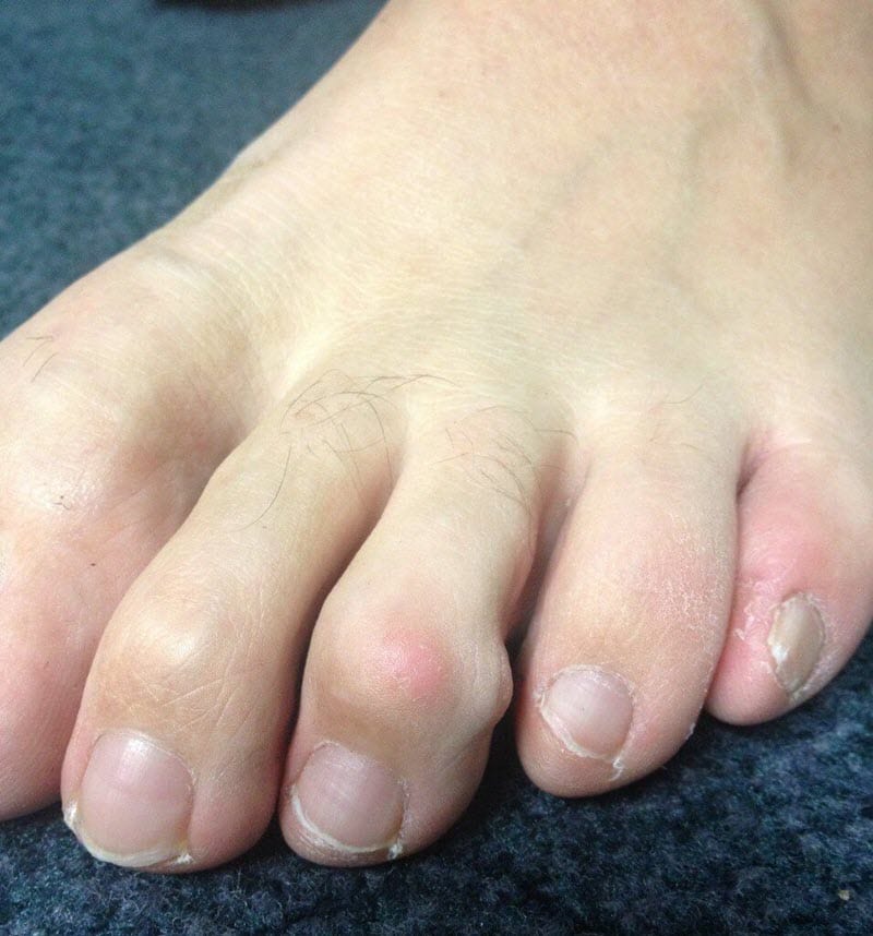 bent toes - mallet toe