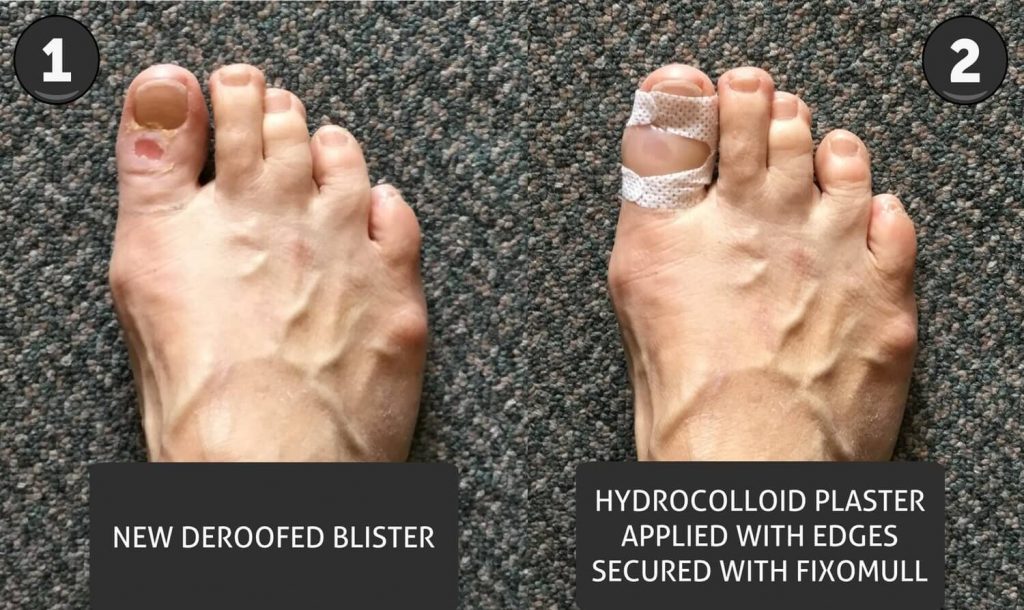 New deroofed blister with hydrocolloid blister plaster applied.