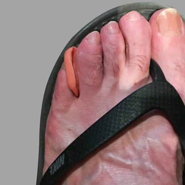 Interdigital Otoform K wedge for painful corn between toes