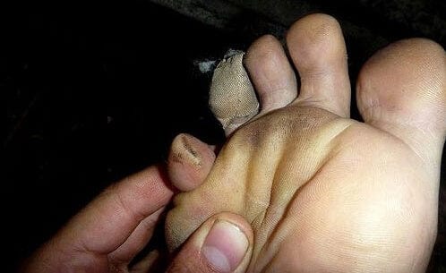 pinch blister pinky toe