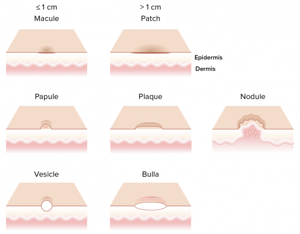 Primary skin lesions