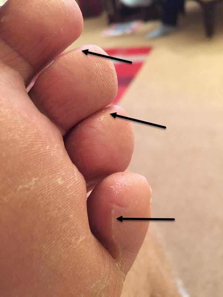 ridged pinch callous likely to blister
