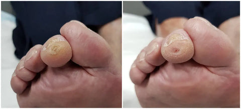 Before & After: This shows a corn on the tip of the second toe with surrounding callous. Nothing is left to the imagination as to where the concentration of pressure is on this toe.