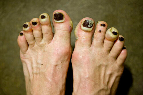 terrible-looking toenail blisters