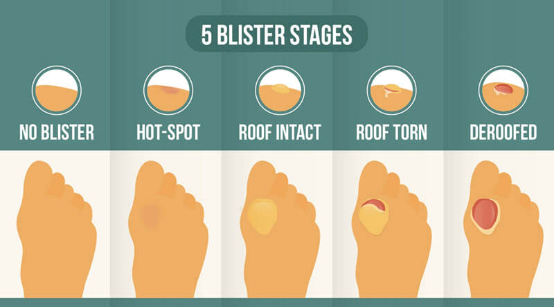 Only use hydrocolloid bandages on the last type of blister - deroofed blisters