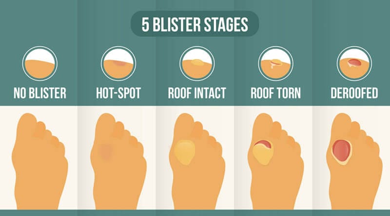 Only use hydrocolloid bandages on the last type of blister - deroofed blisters